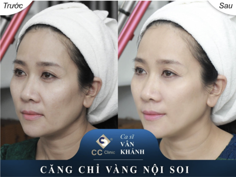 Căng da chỉ vàng