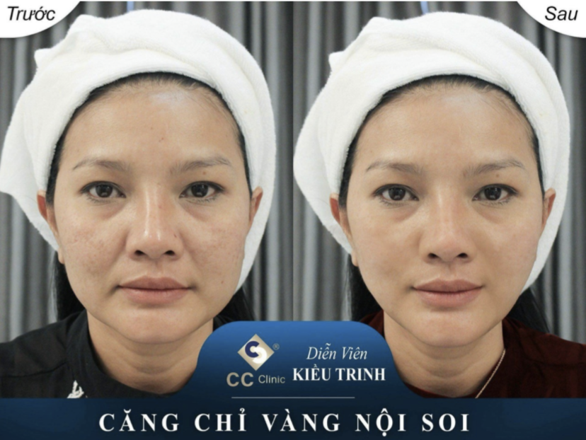 Căng da chỉ vàng