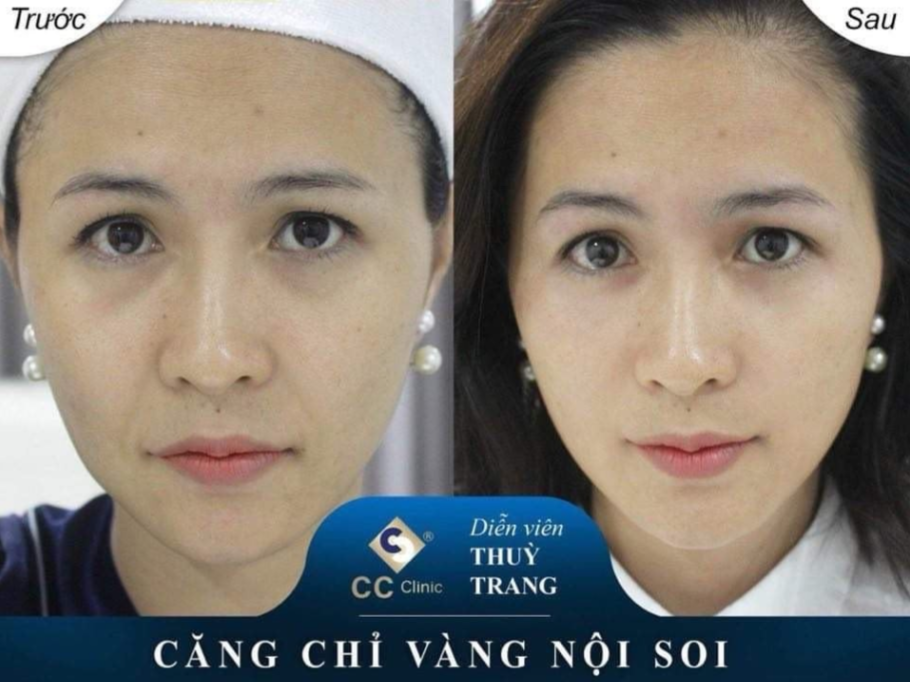 Căng da chỉ vàng