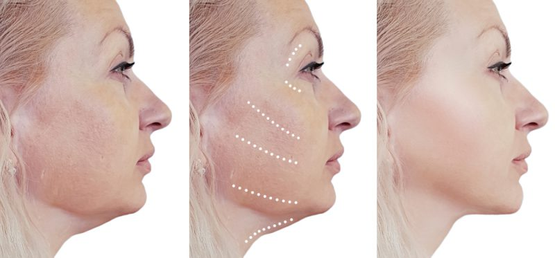 Những điều cần biết khi làm Căng da bằng chỉ